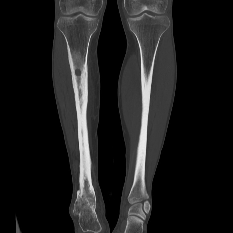 Brodie abscess - tibia (Radiopaedia 66028-75204 Coronal bone window 32).jpg