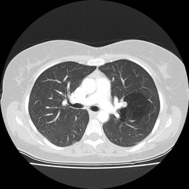 Bronchial atresia (Radiopaedia 22965-22992 Axial lung window 31).jpg