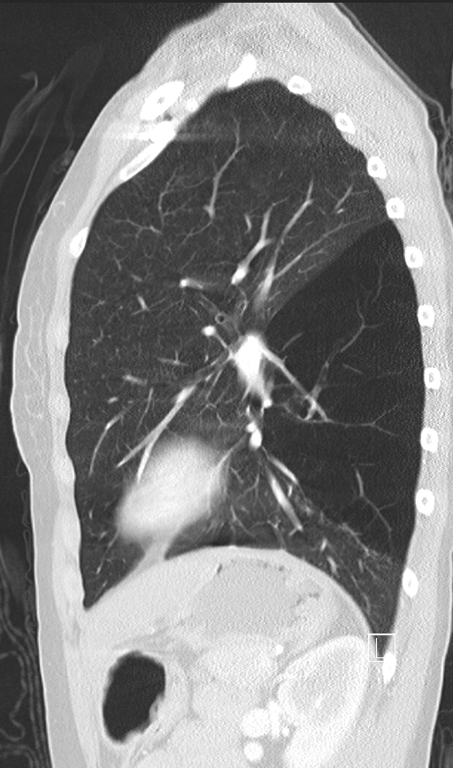 Bronchial atresia (Radiopaedia 73677-84470 Sagittal lung window 37).jpg