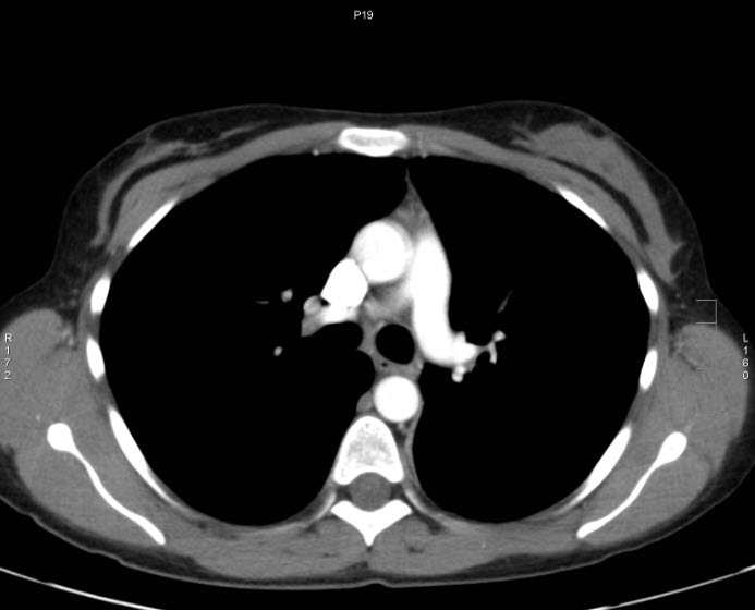 File:Bronchial carcinoid tumor (Radiopaedia 15042-42507 B 1).jpg