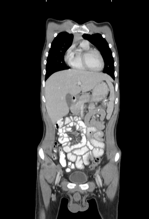 Bronchial carcinoid tumor (Radiopaedia 57187-64090 B 13).jpg