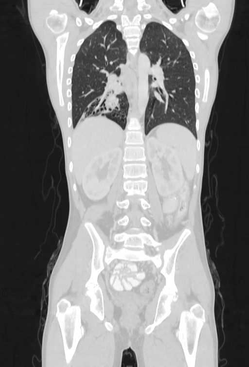 Bronchial carcinoid tumor (Radiopaedia 57187-64090 Coronal lung window 70).jpg