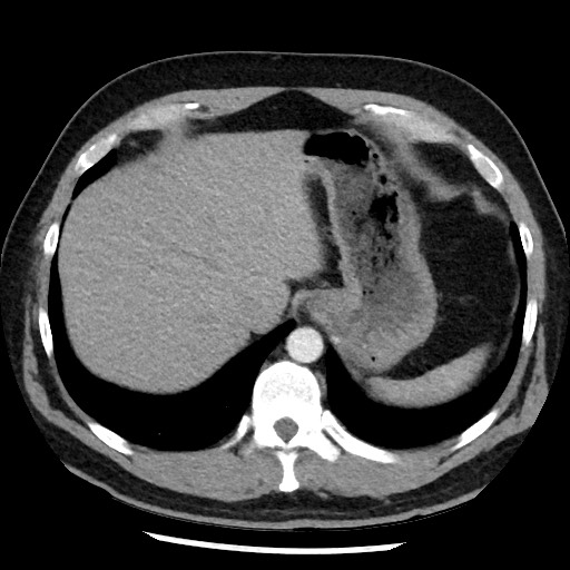 File:Bronchial carcinoid tumor (Radiopaedia 67377-76764 A 53).jpg