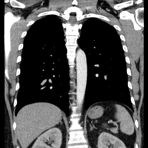 File:Bronchial carcinoid tumor (Radiopaedia 67377-76764 C 45).jpg