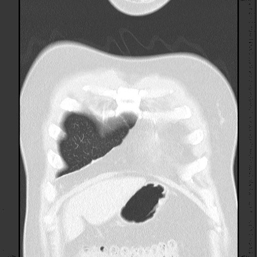 Bronchial carcinoid tumor (Radiopaedia 67377-76764 Coronal lung window 18).jpg