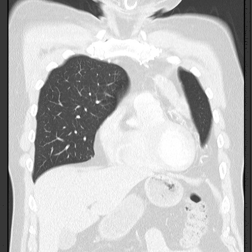 Bronchial carcinoid tumor (Radiopaedia 67377-76764 Coronal lung window 25).jpg