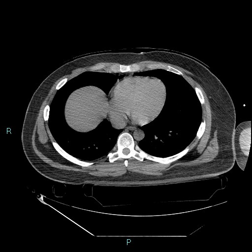 Bronchial carcinoid tumor (Radiopaedia 78272-90870 Axial non-contrast 72).jpg