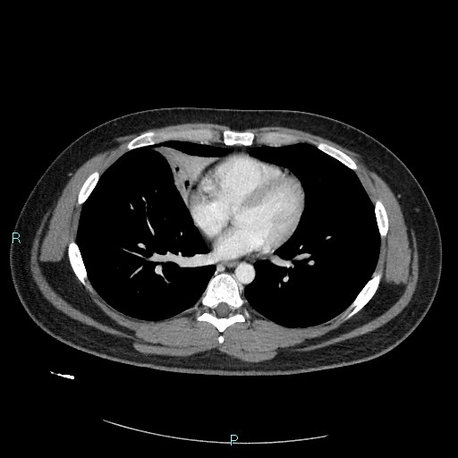 Bronchial carcinoid tumor (Radiopaedia 78272-90875 A 60).jpg