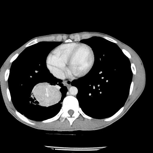 Bronchial carcinoid tumor causing right lower lobe collapse (Radiopaedia 83495-98594 A 36).jpg