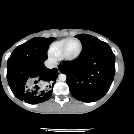 Bronchial carcinoid tumor causing right lower lobe collapse (Radiopaedia 83495-98594 A 40).jpg