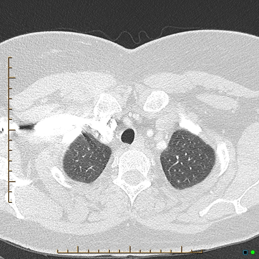 Bronchial diverticula (Radiopaedia 79512-92676 Axial lung window 12).jpg