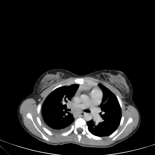 Bronchial mucoepidermoid carcinoma (Radiopaedia 57023-63895 Axial 44).jpg