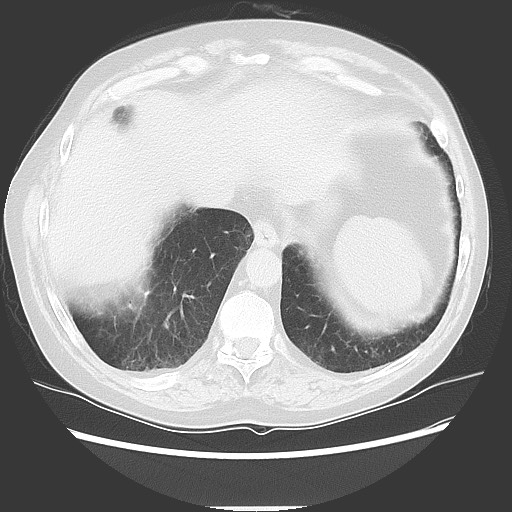 Bronchial stenosis - lung transplant (Radiopaedia 73133-83848 Axial lung window 50).jpg