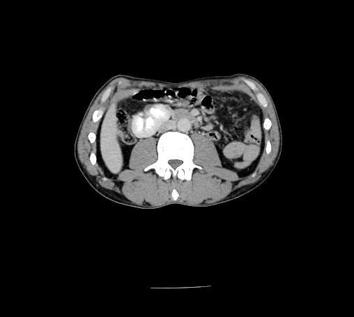 File:Bronchiectasis in Crohn disease (Radiopaedia 60311-67977 B 85).jpg