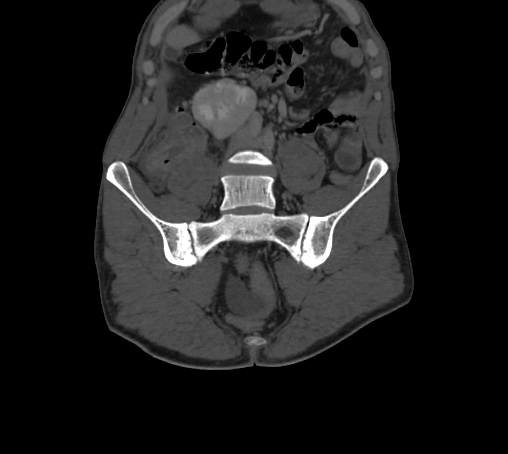 Bronchiectasis in Crohn disease (Radiopaedia 60311-67977 Coronal bone window 16).jpg