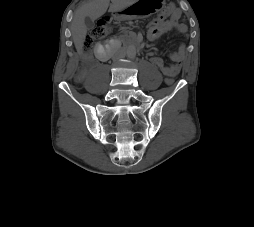 Bronchiectasis in Crohn disease (Radiopaedia 60311-67977 Coronal bone window 33).jpg