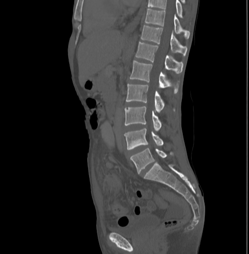 Bronchiectasis in Crohn disease (Radiopaedia 60311-67977 Sagittal bone window 128).jpg
