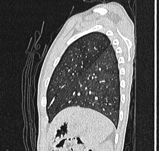 Bronchiolitis obliterans (Radiopaedia 71538-81897 Sagittal lung window 58).jpg