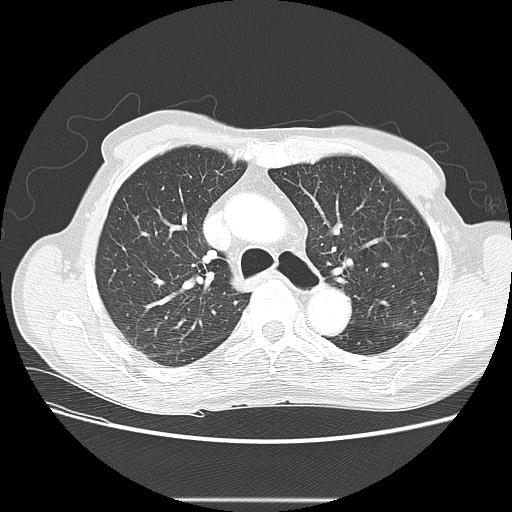 Bronchocele (Radiopaedia 17097-16795 Axial lung window 40).jpg