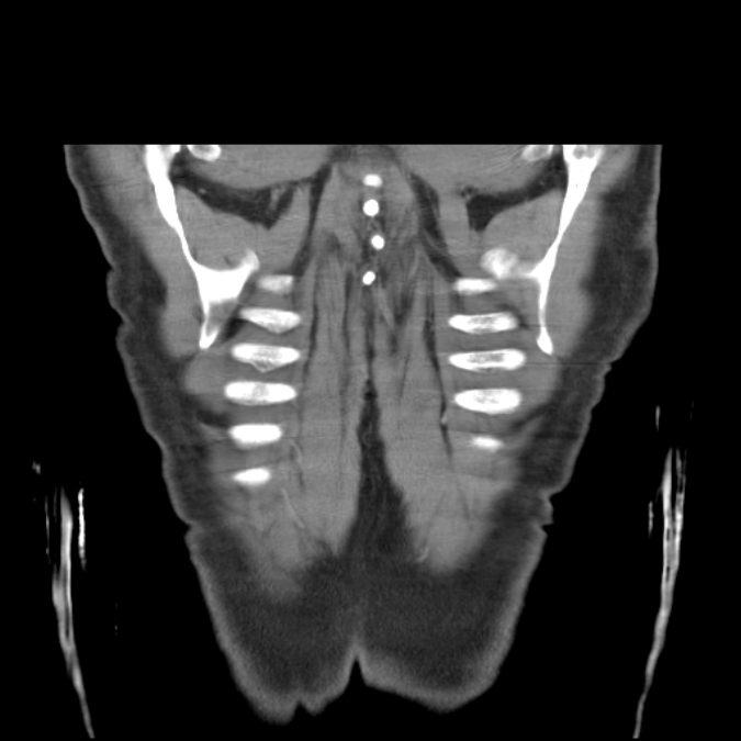 Bronchogenic carcinoma with upper lobe collapse (Radiopaedia 29297-29726 D 53).jpg