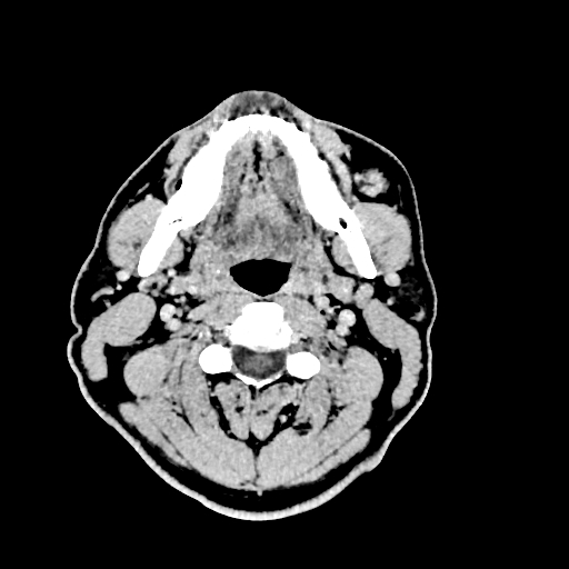 Buccal fat pad arteriovenous malformation (Radiopaedia 70936-81142 Axial non-contrast 13).jpg