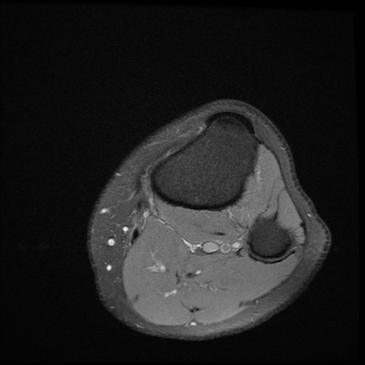 File:Bucket-handle meniscus tear (Radiopaedia 65700-74809 Axial PD fat sat 26).jpg