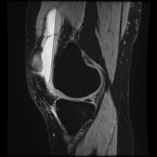Bucket handle meniscus tear (Radiopaedia 56916-63751 H 57).jpg