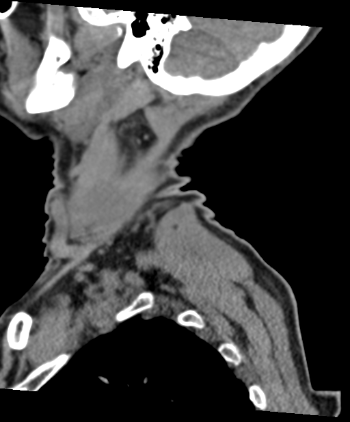 C2 fracture with vertebral artery dissection (Radiopaedia 37378-39199 D 71).png