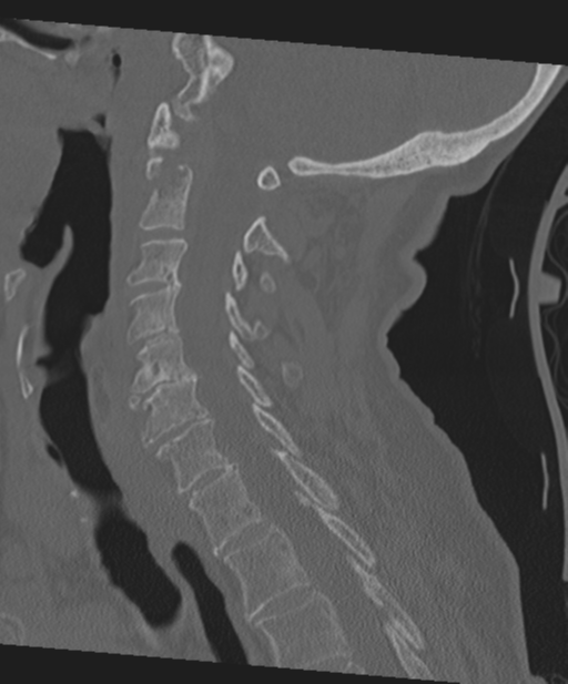 C2 fracture with vertebral artery dissection (Radiopaedia 37378-39199 Sagittal bone window 35).png