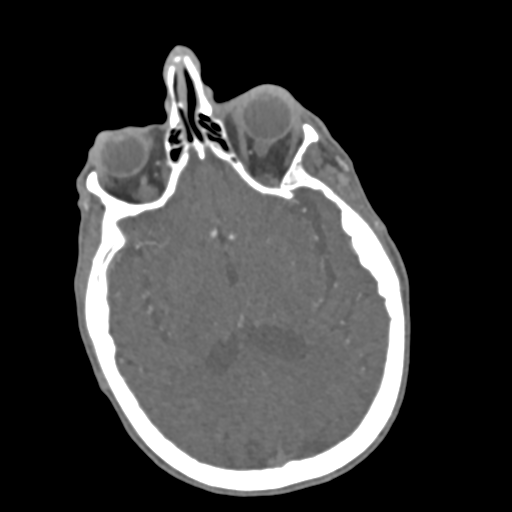 File:C2 fracture with vertebral artery dissection (Radiopaedia 37378-39200 A 248).png