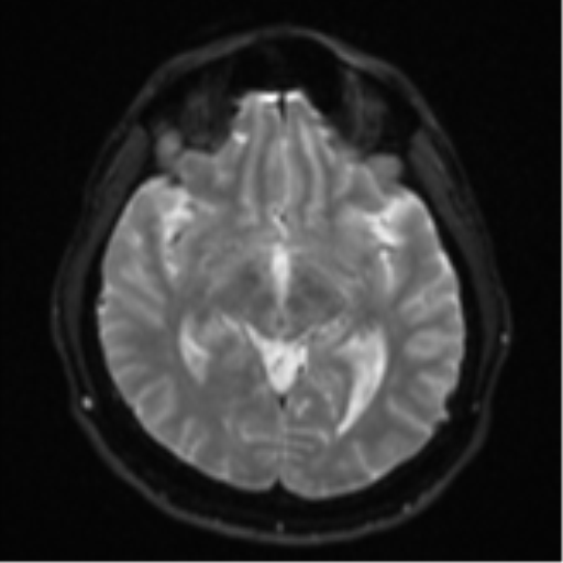 File:CNS vasculitis (Radiopaedia 55715-62263 Axial DWI 13).png