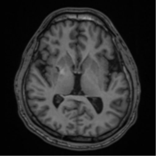 CNS vasculitis (Radiopaedia 55715-62263 Axial T1 30).png
