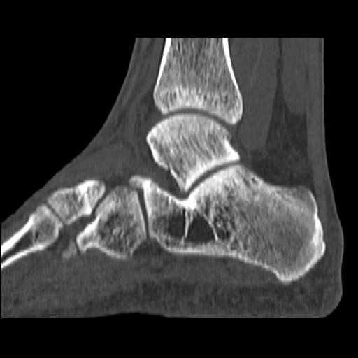 File:Calcaneal intraosseous lipoma (Radiopaedia 12746-12892 Sagittal bone window 1).jpeg
