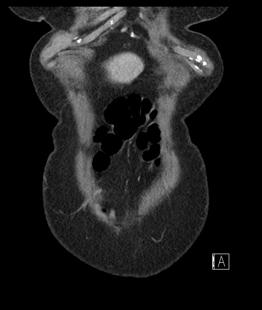 Calcified adrenal glands and Spigelian hernia (Radiopaedia 49741-54988 B 12).jpg