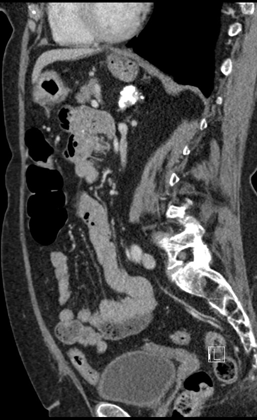 Calcified adrenal glands and Spigelian hernia (Radiopaedia 49741-54988 C 68).jpg