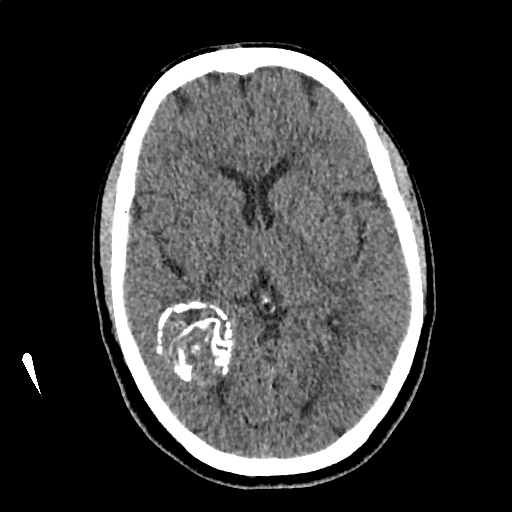 Calcified cerebral hydatid cyst (Radiopaedia 65603-74717 Axial non-contrast 35).jpg