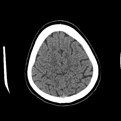 Calcified cerebral hydatid cyst (Radiopaedia 65603-74717 Axial non-contrast 65).jpg