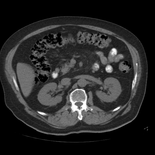 File:Calcified hepatic hydatid cyst (Radiopaedia 18907-18853 Axial non-contrast 25).jpg