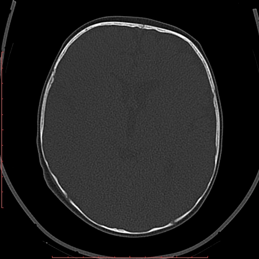 Calcified middle cerebral artery embolism (Radiopaedia 78949-91860 Axial bone window 30).jpg