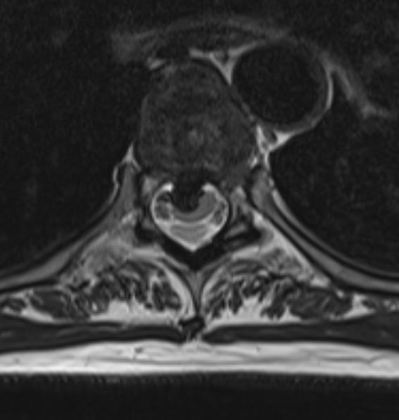 File:Calcified thoracic disc herniation (Radiopaedia 51984-57830 Axial T2 1).JPG