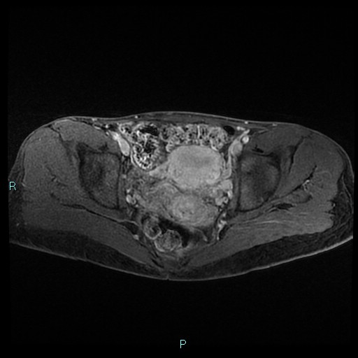 File:Canal of Nuck cyst (Radiopaedia 55074-61448 Axial T1 C+ fat sat 33).jpg