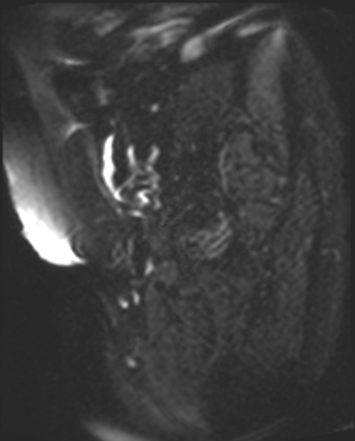 Cancer cervix - stage IIb (Radiopaedia 75411-86615 Sagittal DWI 21).jpg