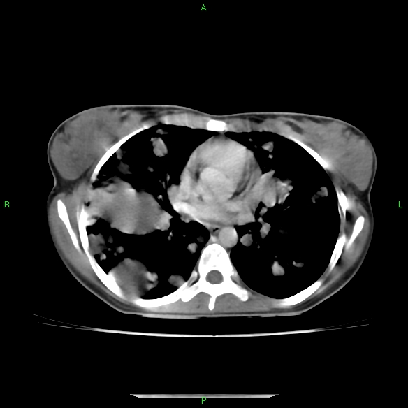 File:Cannon ball metastases - synovial sarcoma (Radiopaedia 26135-26271 C 19).jpg