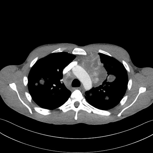 Cannonball metastases - testicular choriocarcinoma (Radiopaedia 84510-99891 B 43).jpg