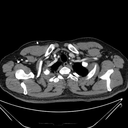 File:Cannonball pulmonary metastases (Radiopaedia 67684-77101 D 24).jpg