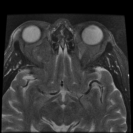 File:Carcinoid tumor of the ileum with metastasis to orbit (Radiopaedia 28165-28424 Axial T2 11).jpg