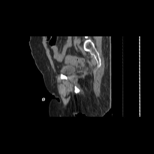 File:Carcinoma cervix- brachytherapy applicator (Radiopaedia 33135-34173 D 129).jpg