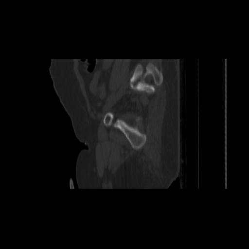 Carcinoma cervix- brachytherapy applicator (Radiopaedia 33135-34173 Sagittal bone window 149).jpg