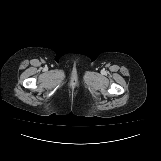 File:Carcinoma colon - hepatic flexure (Radiopaedia 19461-19493 A 140).jpg