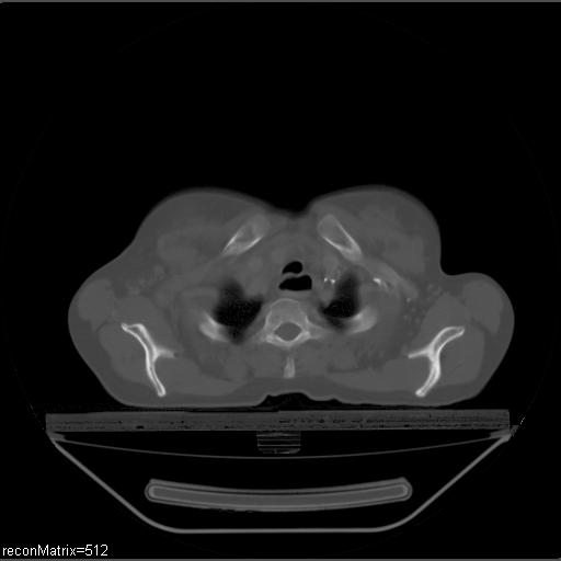 File:Carcinoma of esophagus (Radiopaedia 27356-27550 Axial bone window 29).jpg
